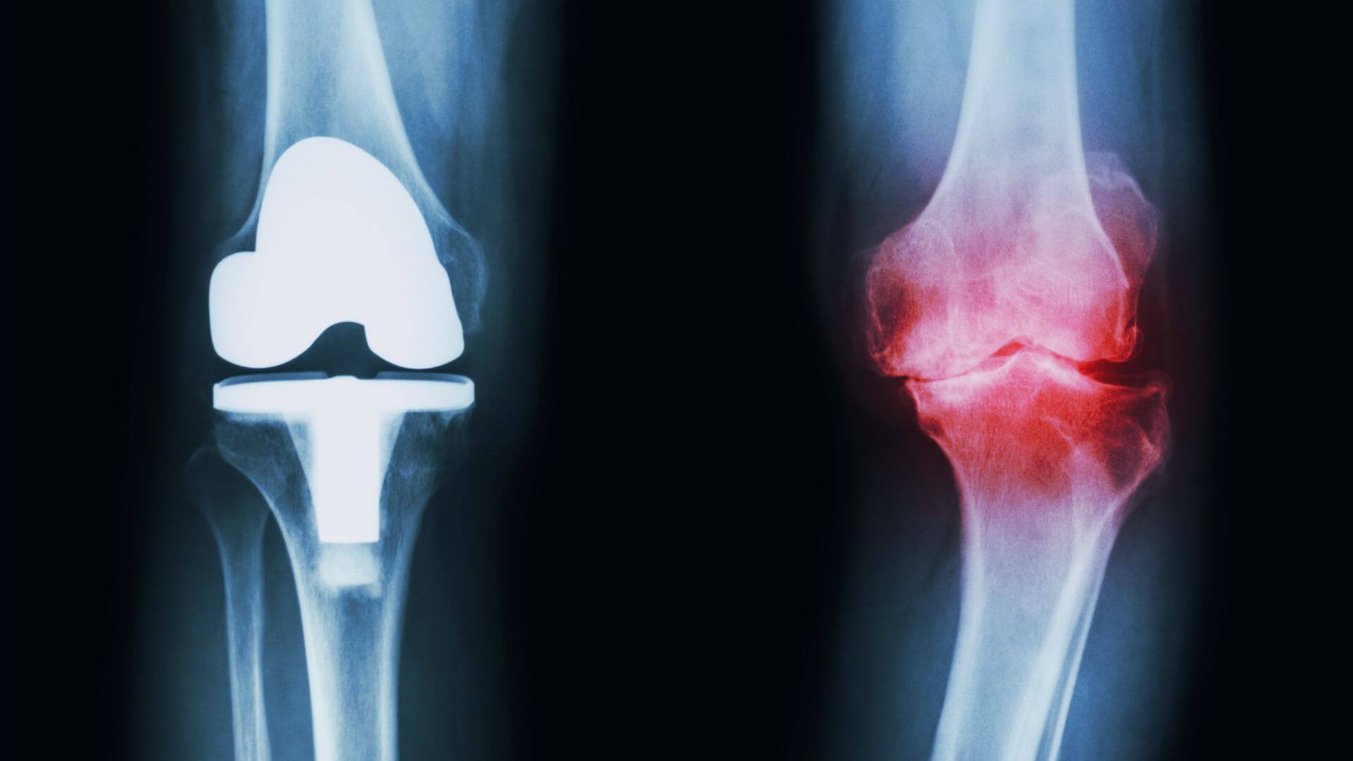 Clínica Cord - osteoartrite de Joelho